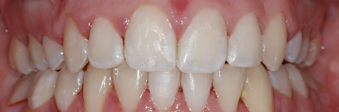  After Clean Teeth