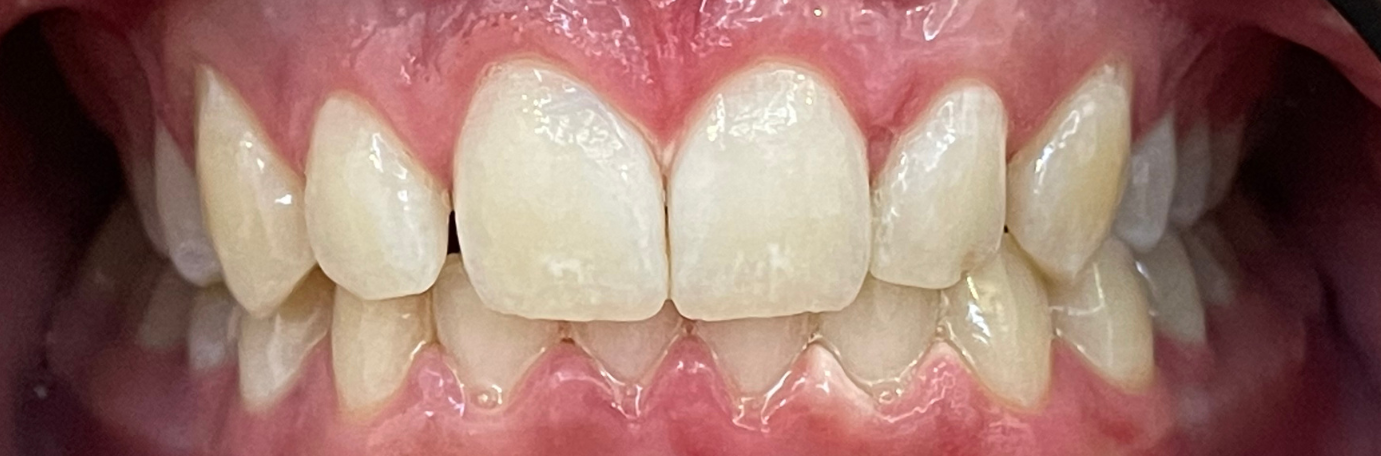  Before Clean Teeth