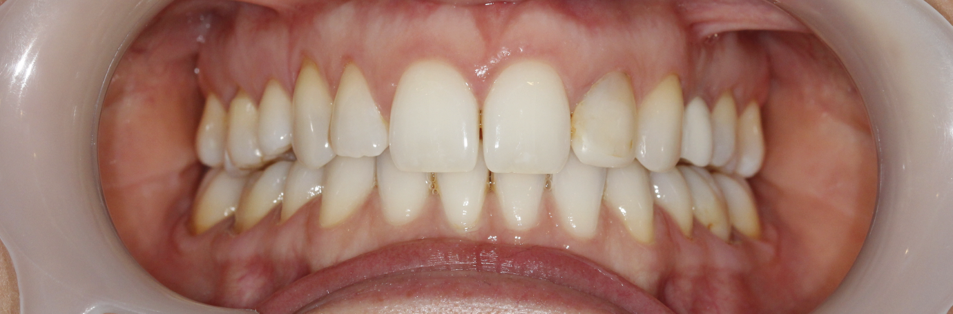  Before Clean Teeth